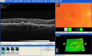 Scan 2. Dry AMD (Atrophy)