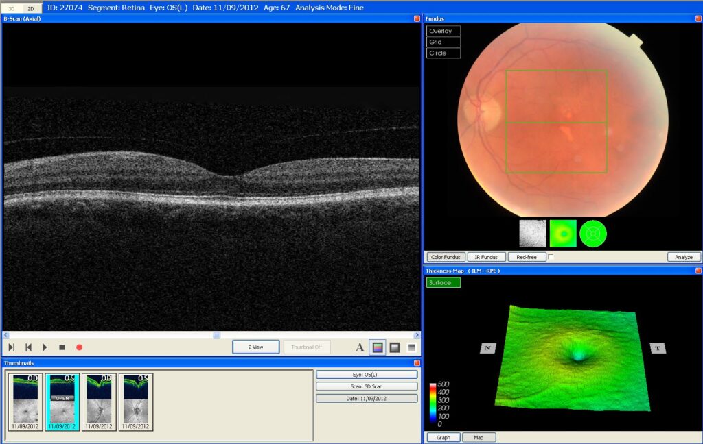 Healthy Macula