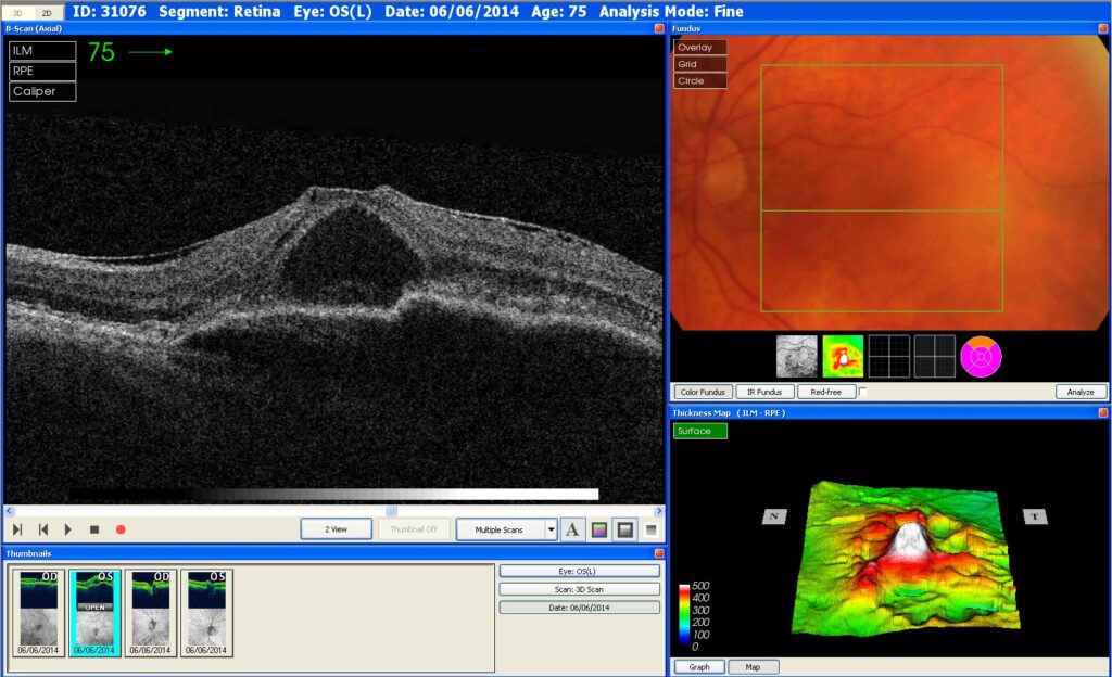 This is a scan of an eye with Wet AMD