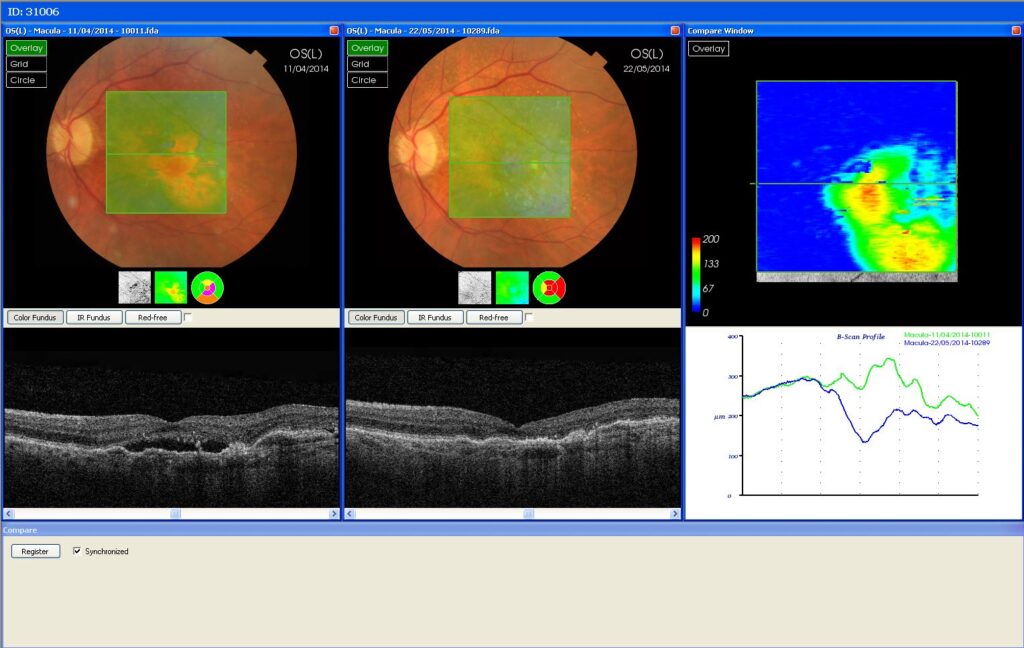 Wet AMD before and after 1 Lucentis injection